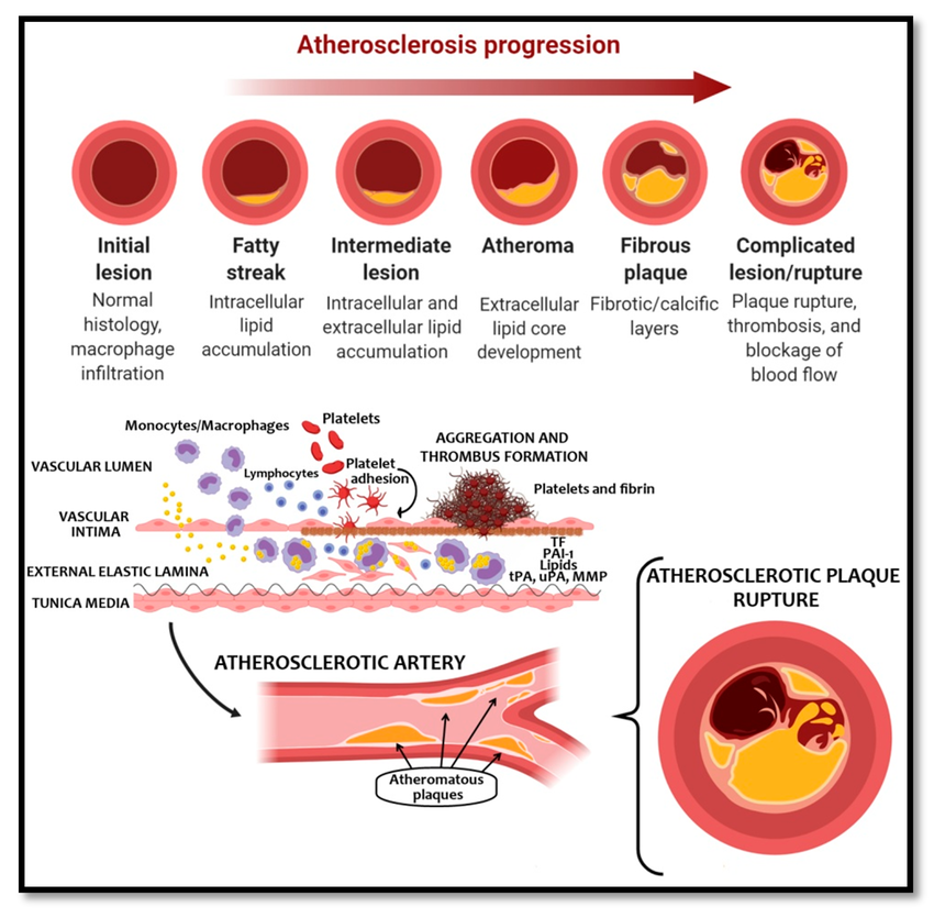 Системное воспаление и нарушения свертывания крови, возникающие при инфекциях, включая COVID, могут способствовать разрыву бляшки и тромбозу.