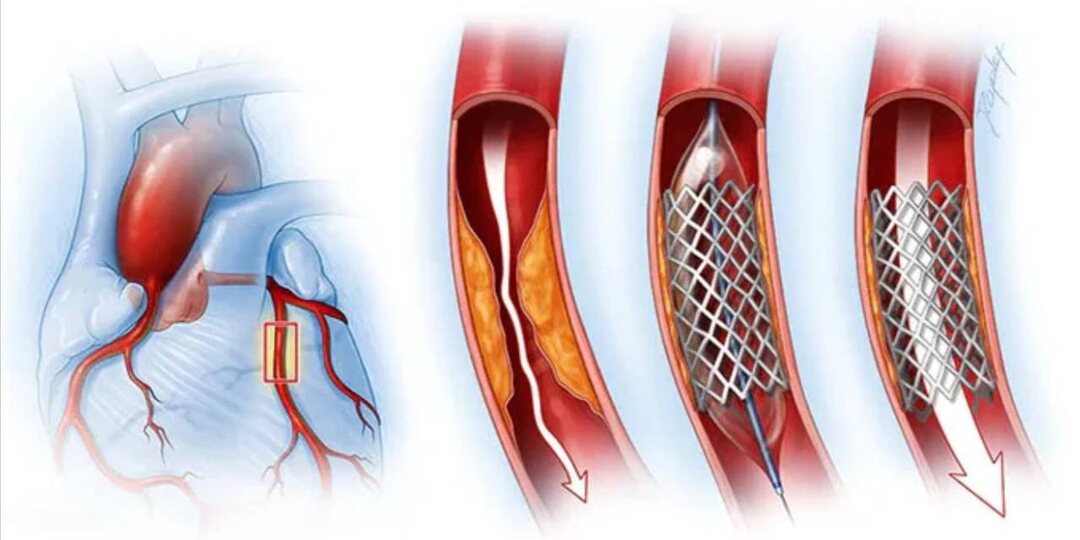 Про стентирование: что это и какие ограничения после процедуры