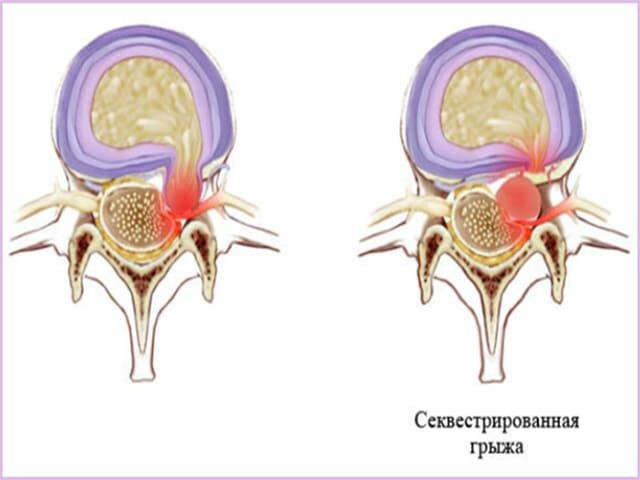 Отрезать или само заживет. Правда о грыже позвоночника