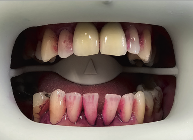 Рис.3 Визуализация мягких и твердых отложений после промывки