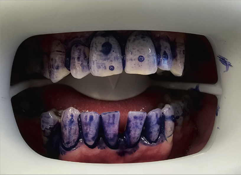 Рис.2 Окрашивание зубов раствором mira-2-ton