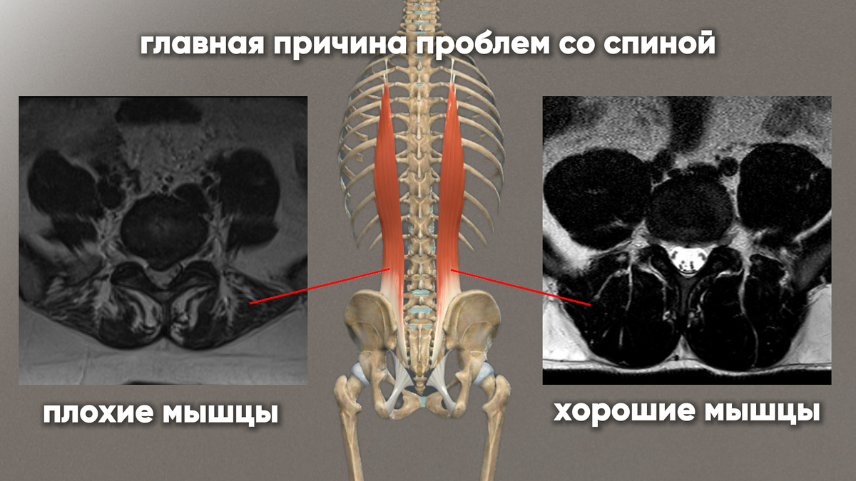Слева человек который ничем не занимается и постоянно испытывает боль в спине, справа человек который сделал МРТ потому что сильно упал, катаясь на лыжах, в итоге спина поболела пару дней и прошла, а за счет крепких мышц он не получил более сильных повреждений.