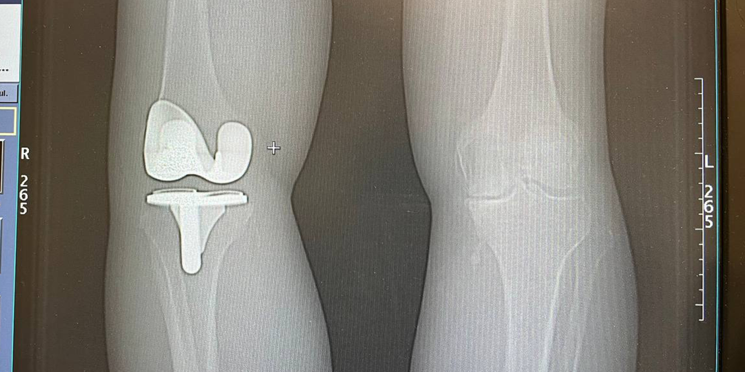 6 лет боли в колене — и одно решение, которое вернуло движение