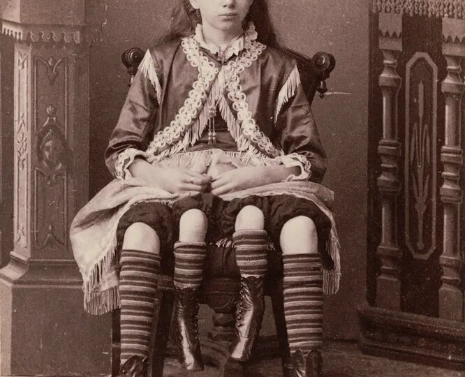 Жозефина Миртл Корбин: Четырехногая леди. Как женщина с удвоением таза смогла выйти замуж, родить пятерых детей и стать звездой шоу