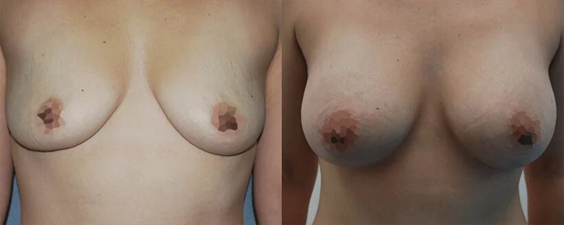 Фото до и после. Фото с сайта хирурга Д.Р. Гришкяна. Имеются противопоказания, требуется консультация специалиста.