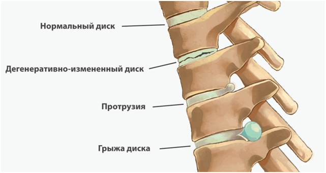Схема формирования грыжи межпозвоночного диска