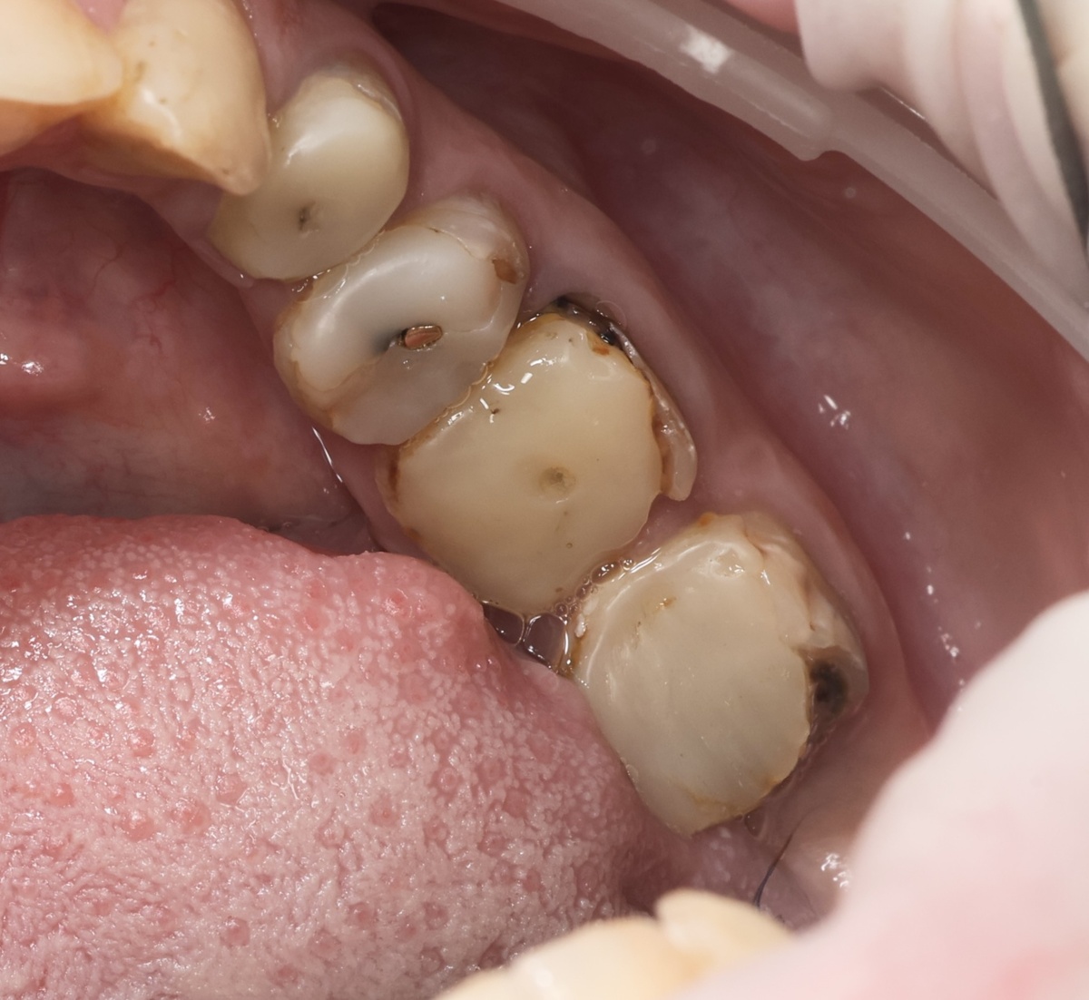 Состояние зубов "до"