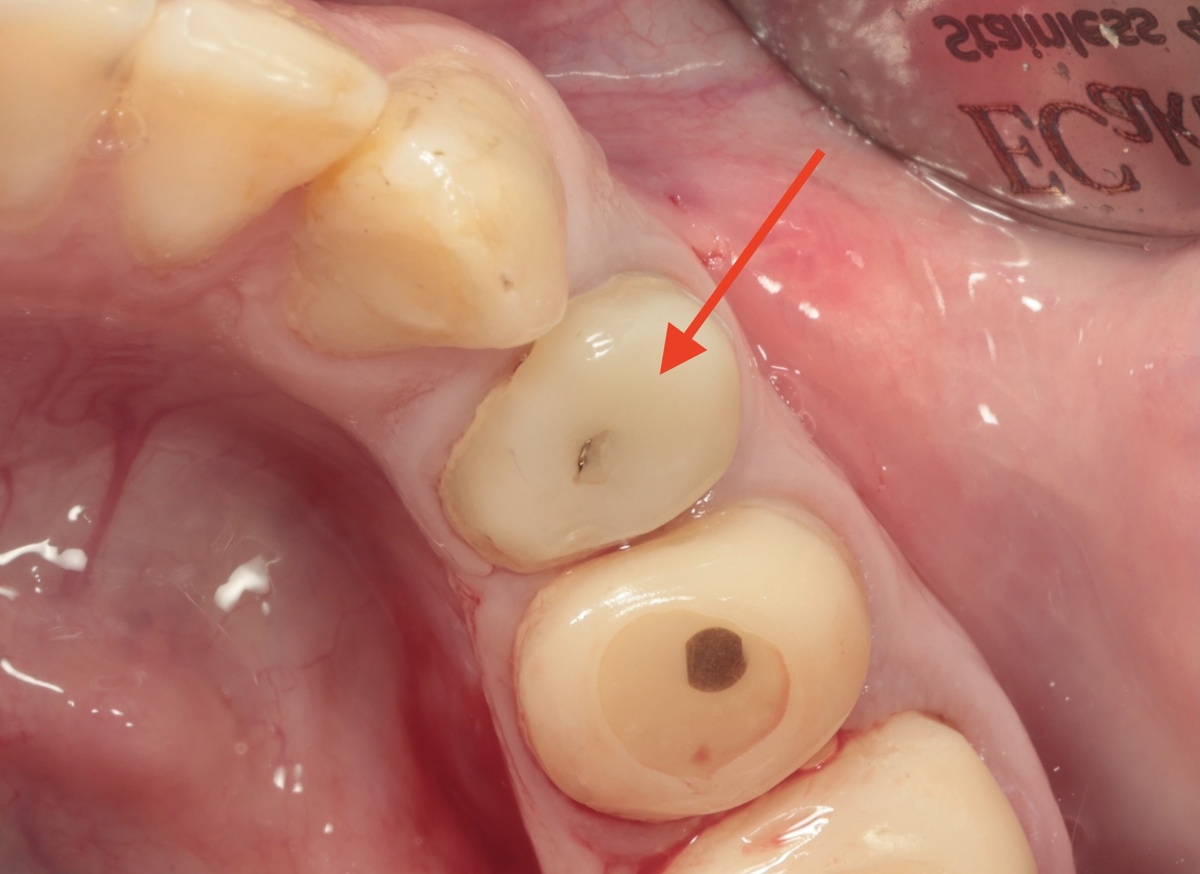 Зуб 3.4 отмечен красной стрелкой, состояние до лечения