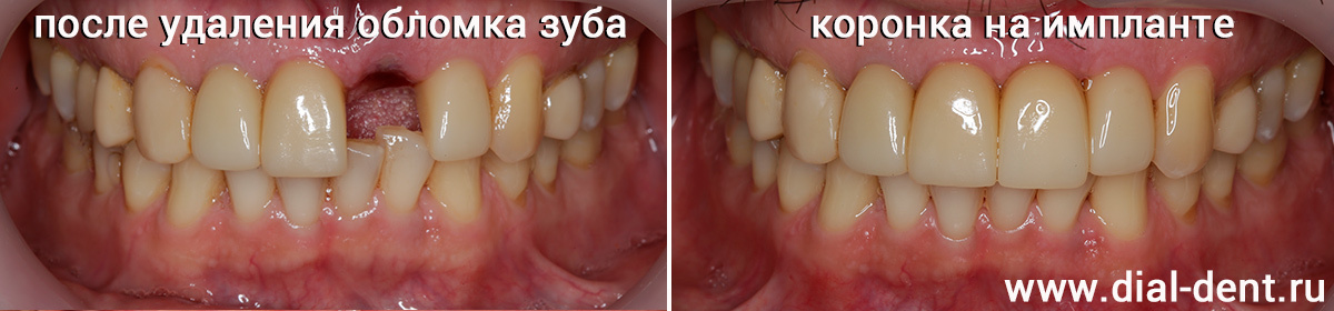 восстановление зуба после травмы коронкой на импланте
