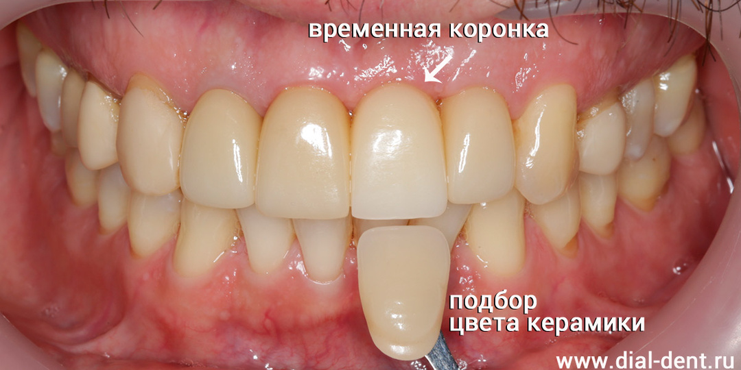 Современный имплант Primetaper от компании Astra Tech - лучшего производителя имплантов