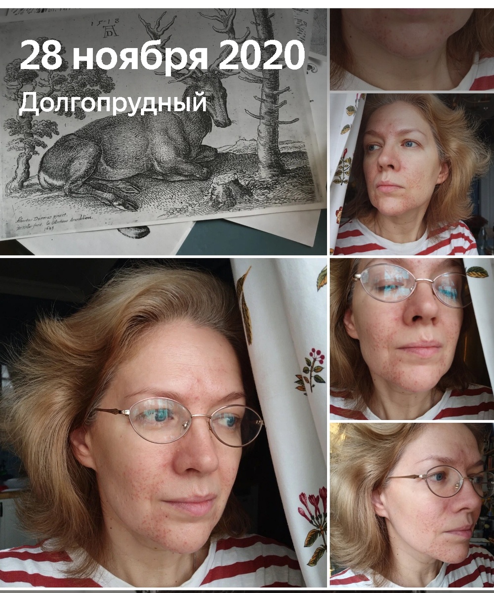 Эти фотографии я делала, для отчёта. Мой врач просила отправлять каждые 10 дней. Я тогда много времени проводила в поездках и врач писала мне что оставить, а что заменить во внешнем уходе. 