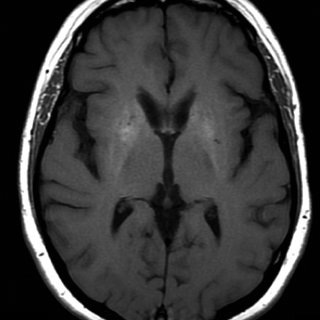 ИИ читает МРТ мозга за секунды и мгновенно выявляет угрозу жизни