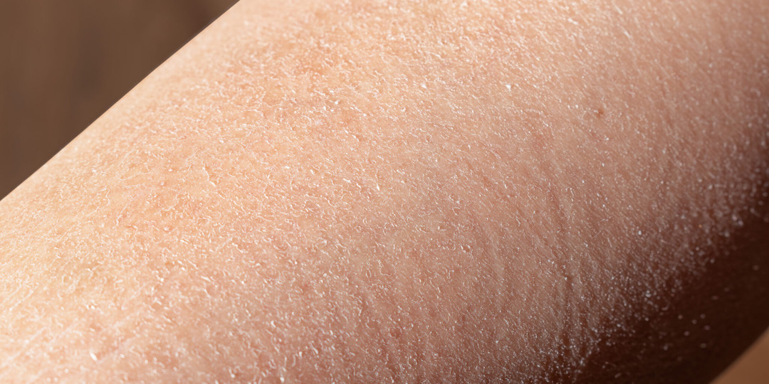 Шелушение Кожи, Которое Не Проходит Месяцами