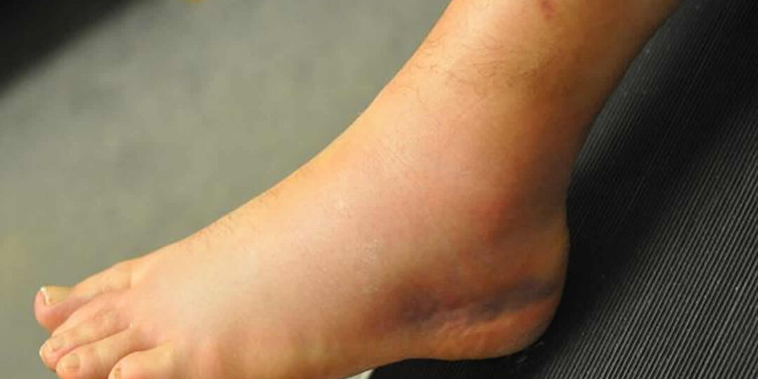 Отёки Лодыжек К Вечеру — Когда Это Не Просто Усталость