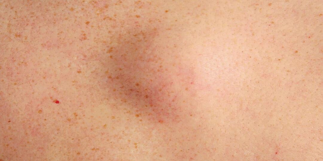 Узелок Под Кожей, Который Растёт Медленно