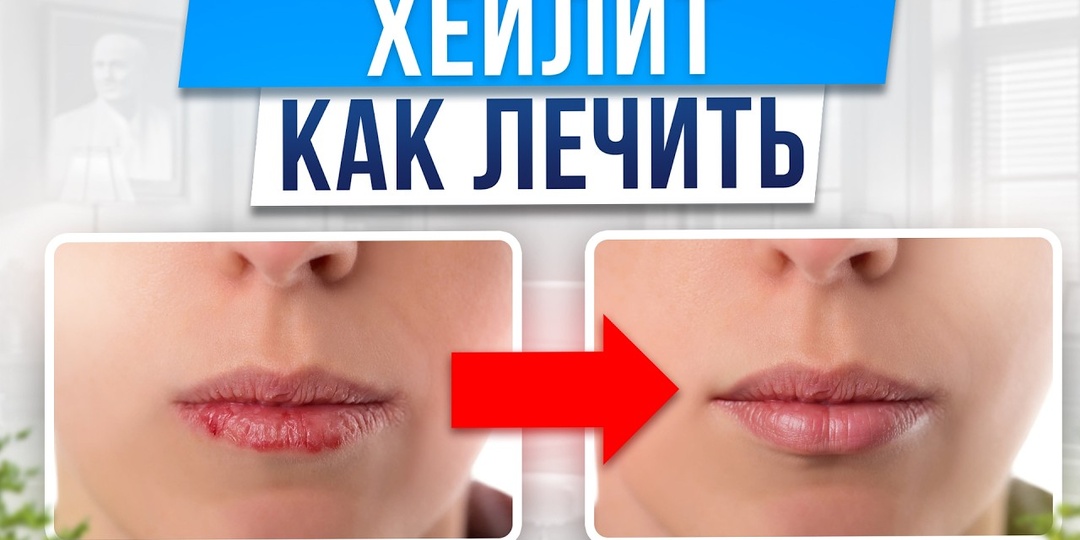 Сухость во рту и трещины в уголках губ — Возможные Причины