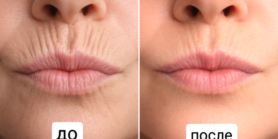 Морщины над губой старят лицо сильнее всего. Три приёма, которые реально помогают их разгладить