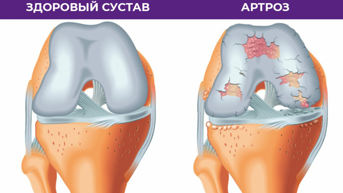 В крупных городах Санкт-Петербург и Москва охват артрозом достиг 14–15%. 