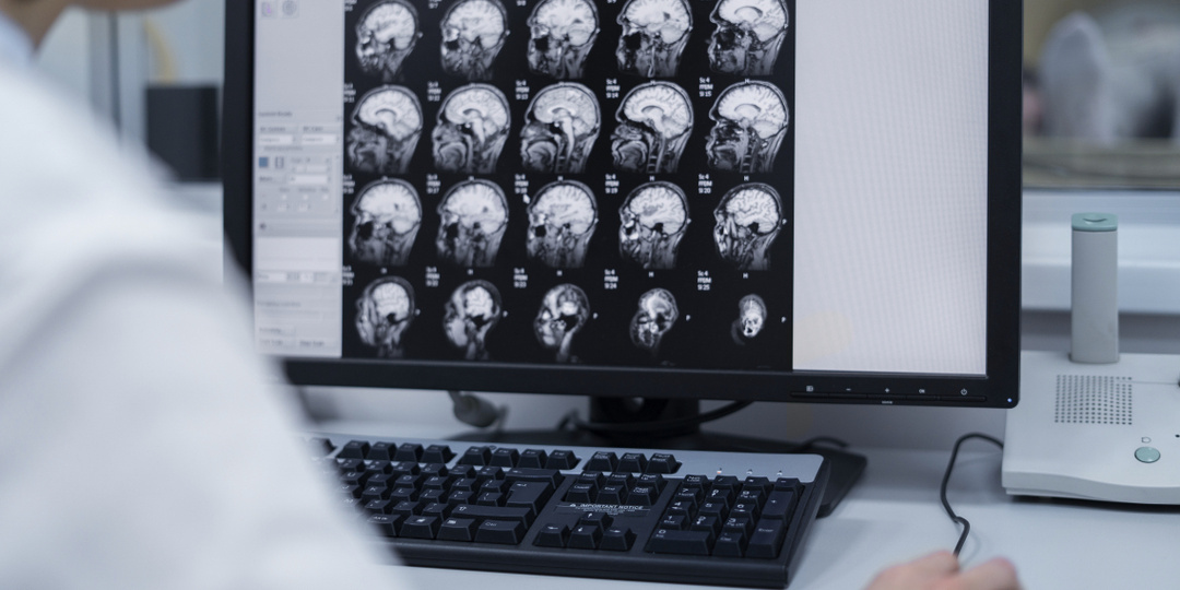 Как понять, что у вас эпилепсия: симптомы и признаки