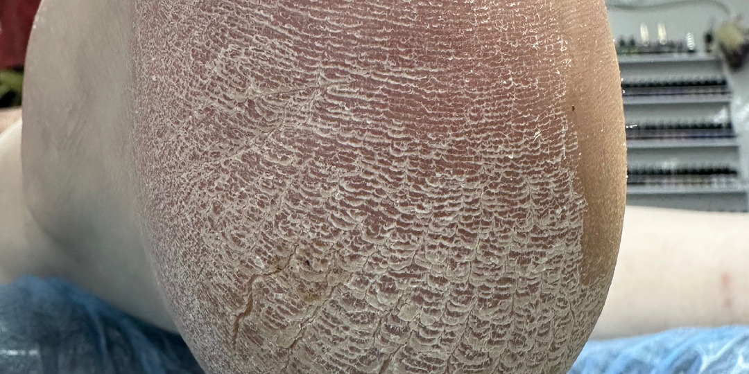 Почему «домашний уход» часто заканчивается трещинами?