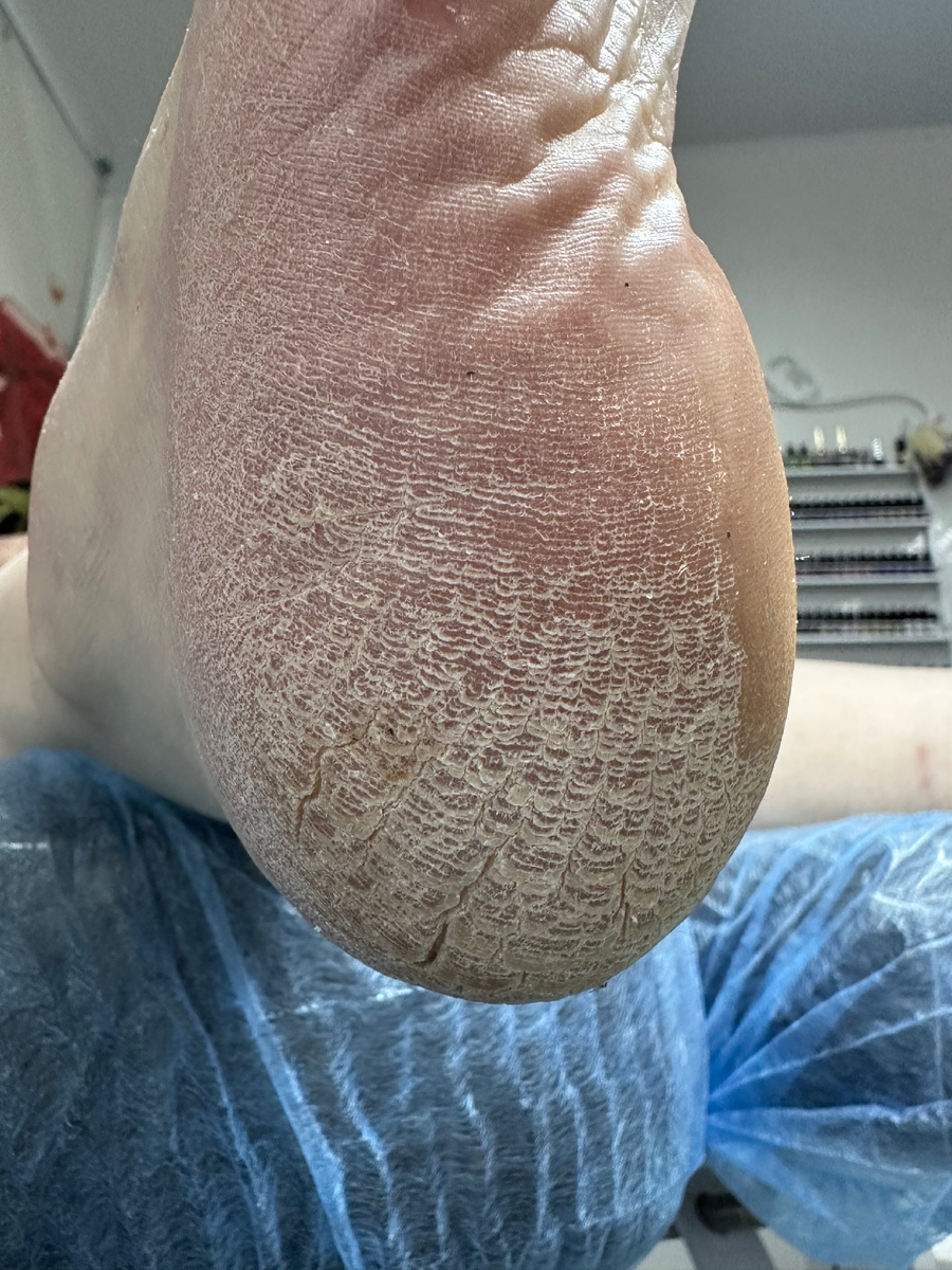 Трещины на пятках - основная проблема 90% людей