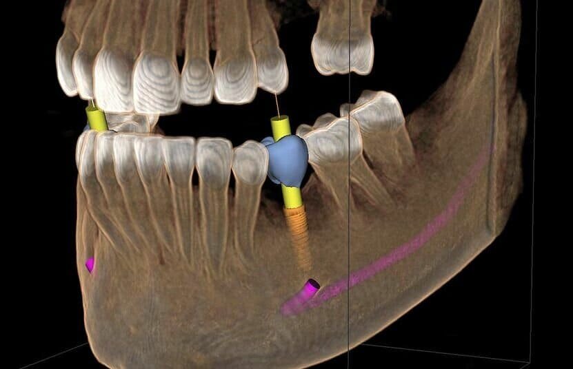 Место установки импланта над выходом нижнечелюстного нерва