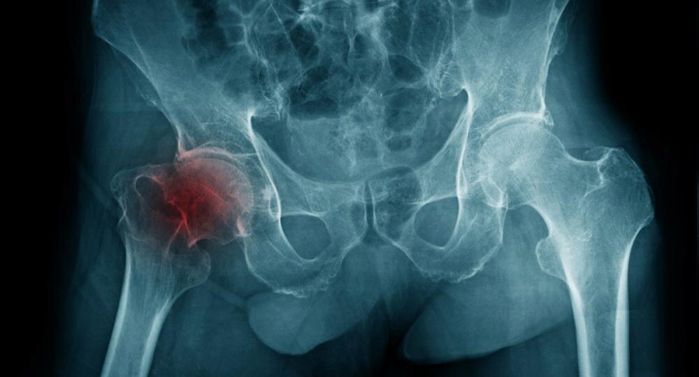 Коксартроз: можно ли остановить разрушение сустава и вернуть себе свободу движений?