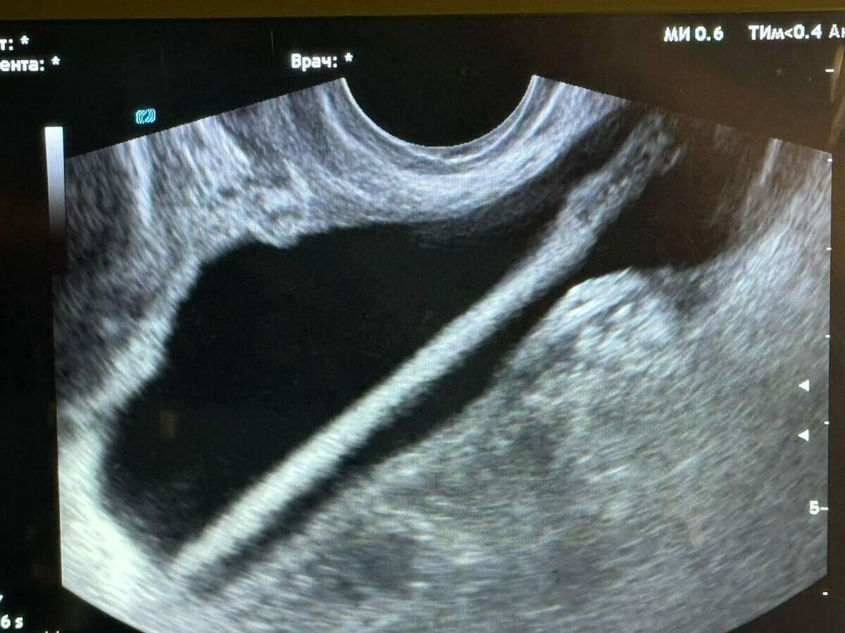    Подмосковные врачи достали из мочевого пузыря пациентки косметический карандаш | © Министерство здравоохранения Московской области