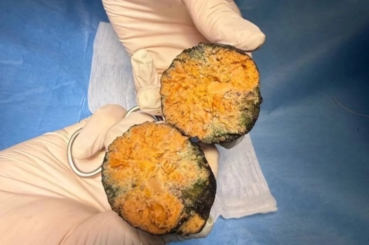    Фитобезоар из хурмы