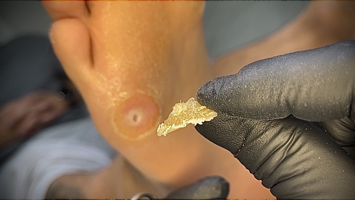 Сухая стержневая мозоль на стопе