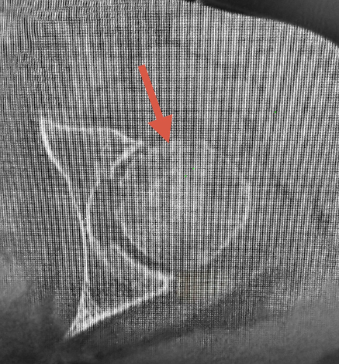 Фрагмент хряща с костью