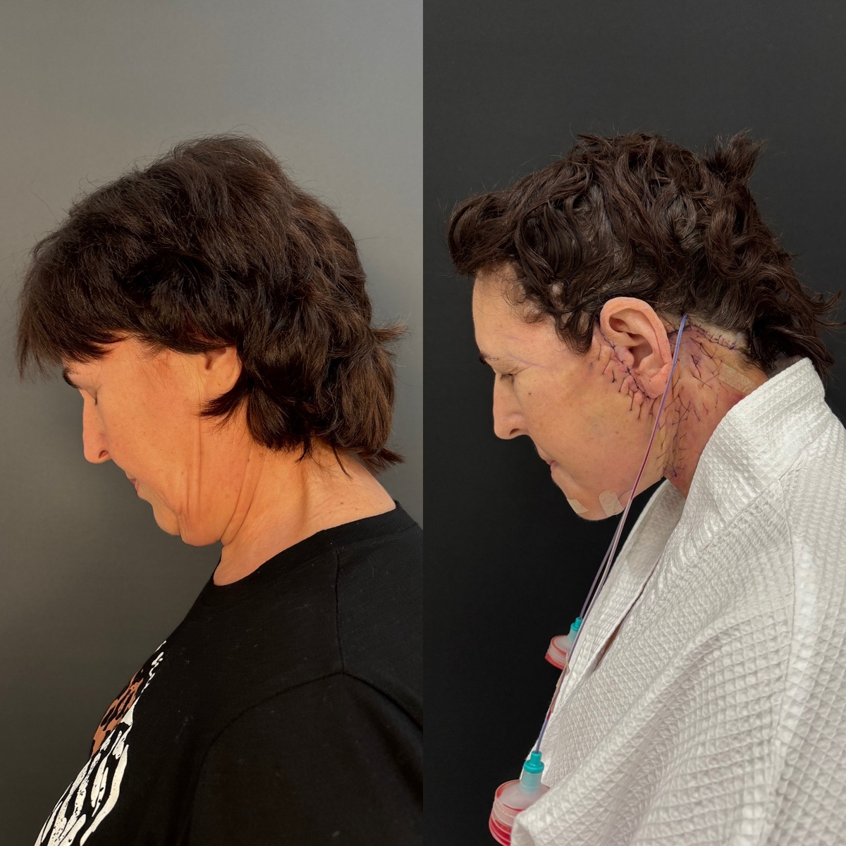 Пациентка на первые сутки после смас- подтяжки нижней трети лица и шеи: сетка Освальда. Хирург Остринская Т. В.