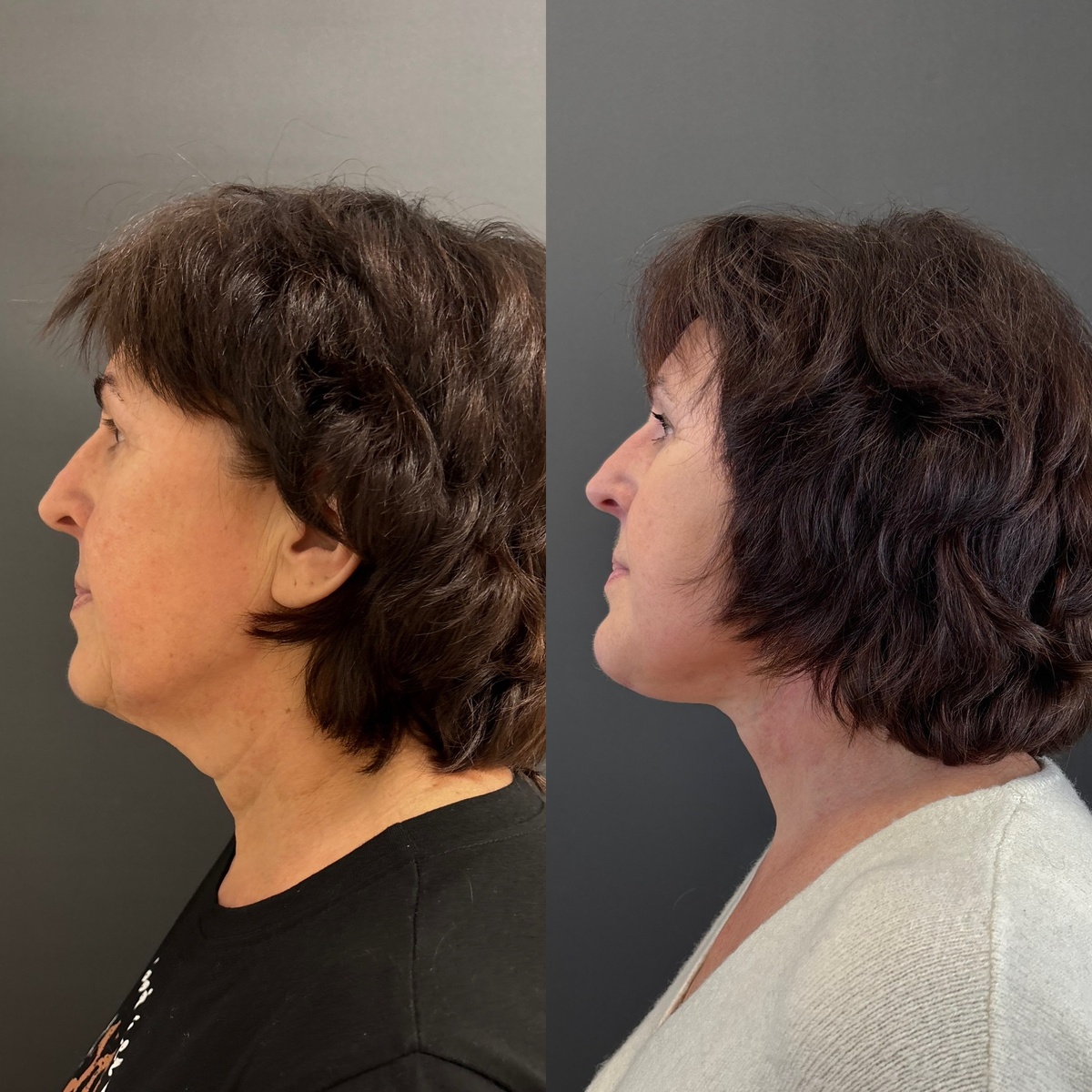 Пациентка через месяц после смас- подтяжки нижней трети лица и шеи: сетка Освальда. Хирург Остринская Т. В.