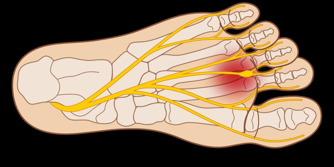 Онемение пальцев ног — когда это уже не про обувь