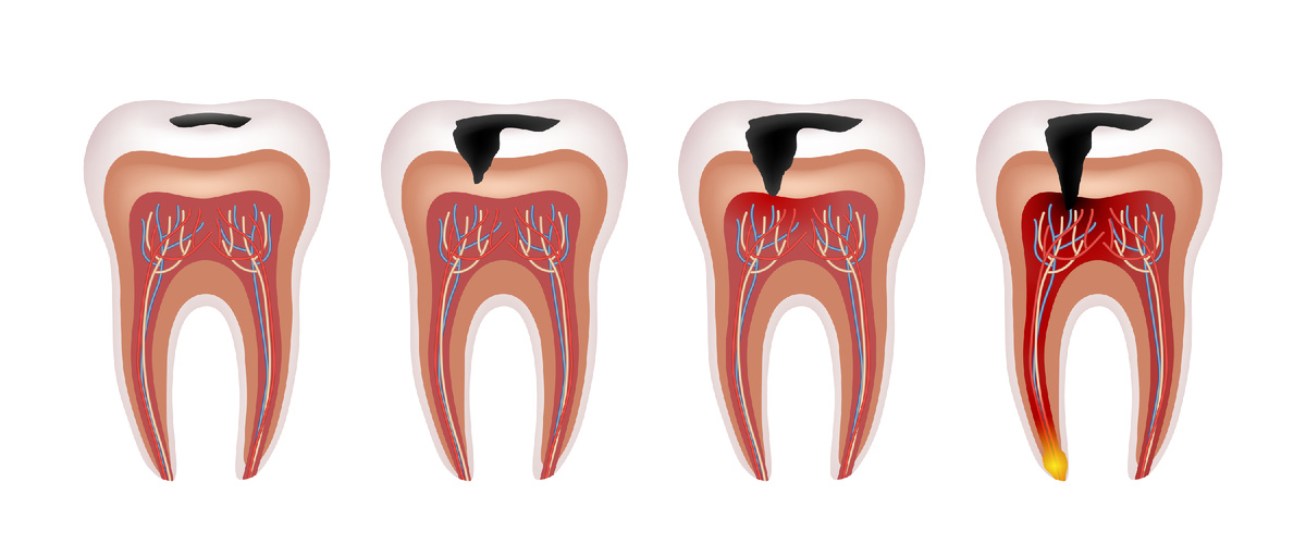 Поэтапное углубление кариеса от эмали к пульпе