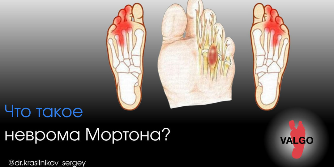 Жжение в стопе и «камешек» в обуви? Это может быть неврома Мортона