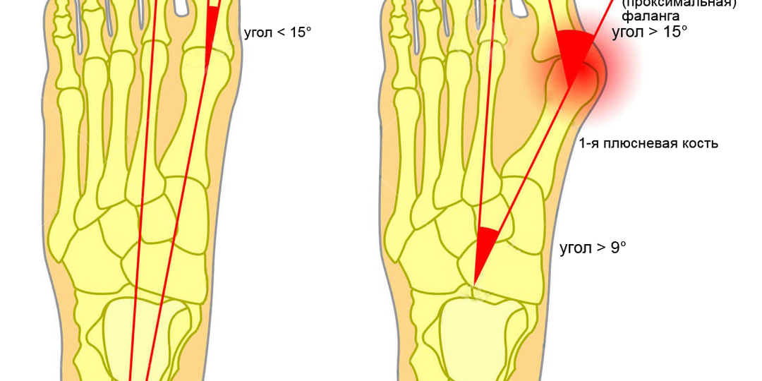 Hallux Valgus: когда «косточка» — это уже диагноз, а не косметика