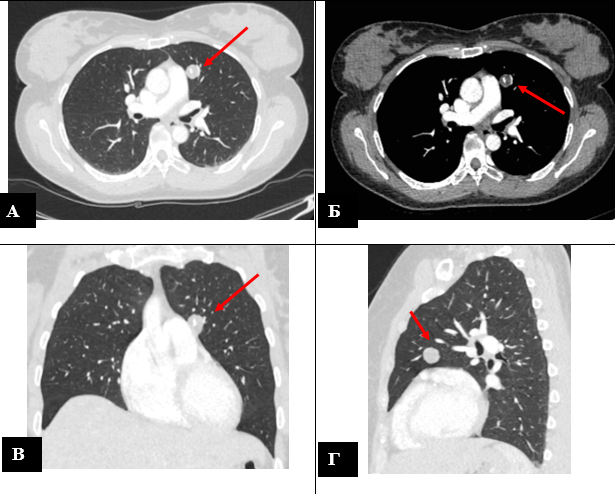 Периферическое новообразование верхней доли левого легкого (гамартома?) – указано стрелкой. Компьютерная томограмма органов грудной клетки в аксиальной проекции: легочный режим (А), средостенный режим (Б); фронтальной проекции (В); сагиттальной проекции (Г).