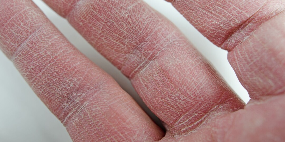 Трещины на коже пальцев, которые долго не заживают