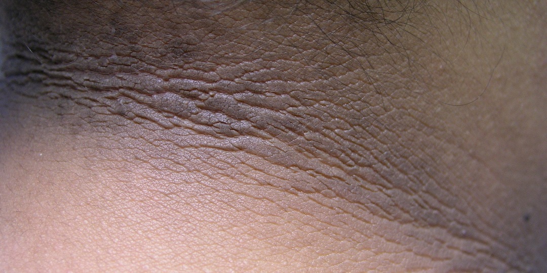 Потемнение кожи в одной зоне — что врачи считают настораживающим