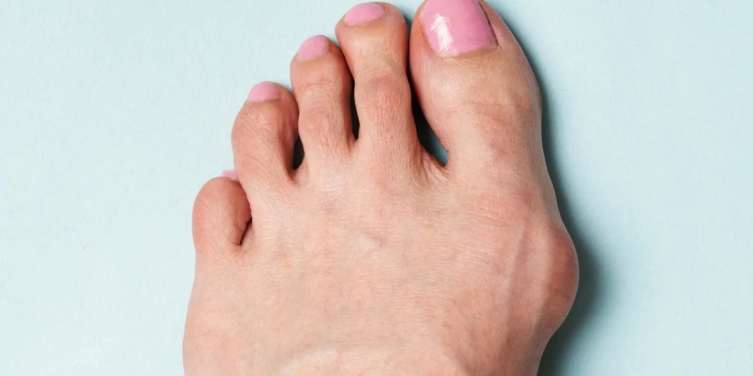 Шишка на стопе, которая постепенно увеличивается