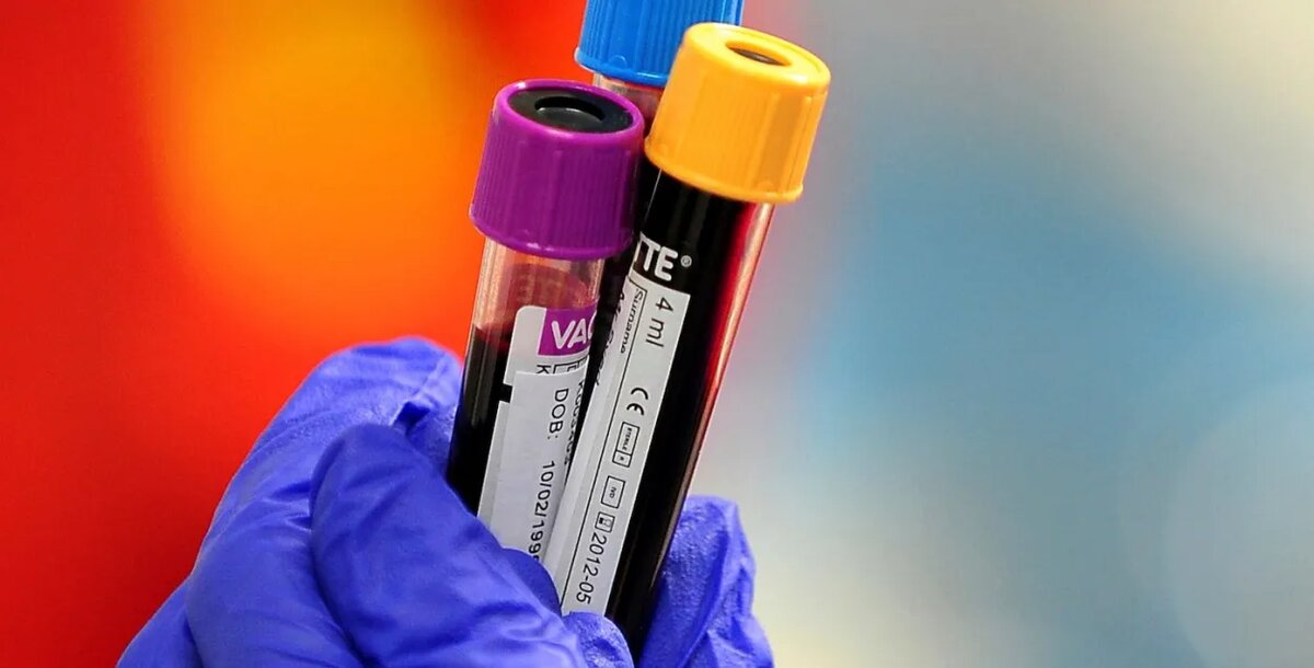 Новый анализ крови выявляет рак поджелудочной железы до того, как он станет смертельно опасным