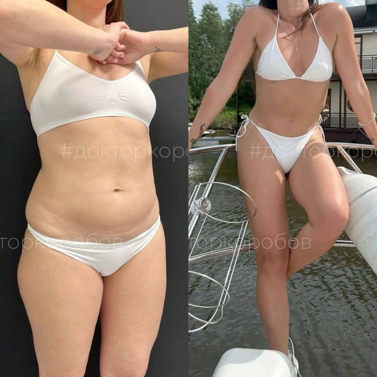 Липосакция живота, пояснично-боковых областей, спины и внешней поверхности бедер (зоны галифе). Результат через полгода после операции