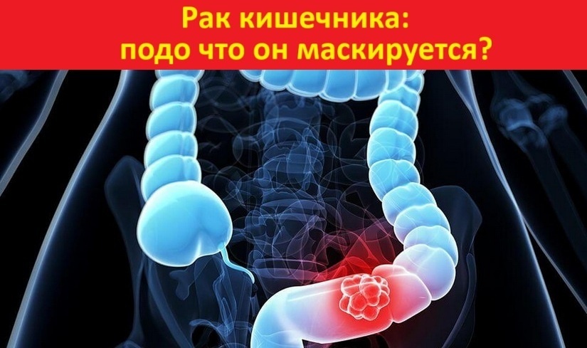 Рак кишечника: как он маскируется под «просто расстройство» и когда бить тревогу