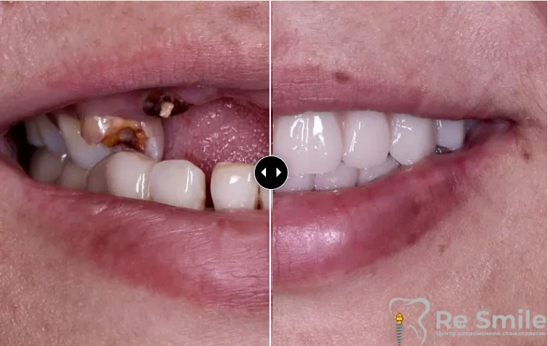 Пациентка обратилась с жалобами на расфиксацию и выпадение ортопедической конструкции на верхней челюсти, а также разрушенность и подвижность зубов на нижней челюсти.

Было произведено удаление несостоятельных зубов и корней с одномоментной имплантацией по системе All-on-6 и немедленной нагрузкой временными адаптационными протезами.