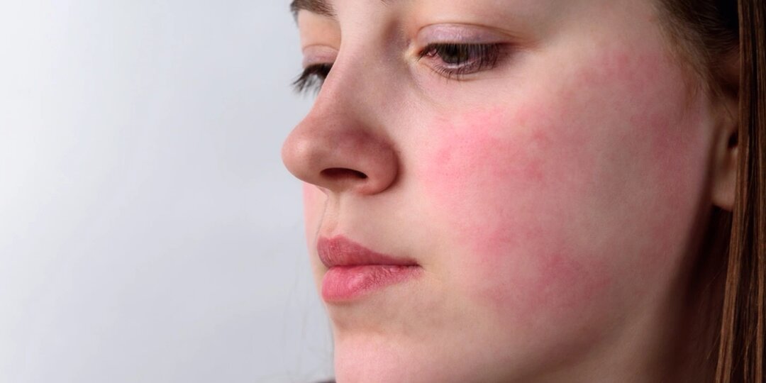 Резкое покраснение кожи лица без причины