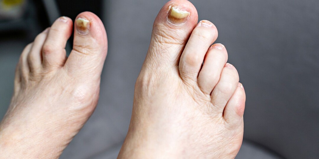 Утолщение ногтей на ногах — что это может сигнализировать