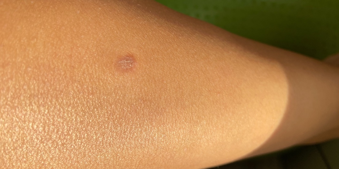 Темное пятно на коже, которое не проходит — когда дерматологи бьют тревогу