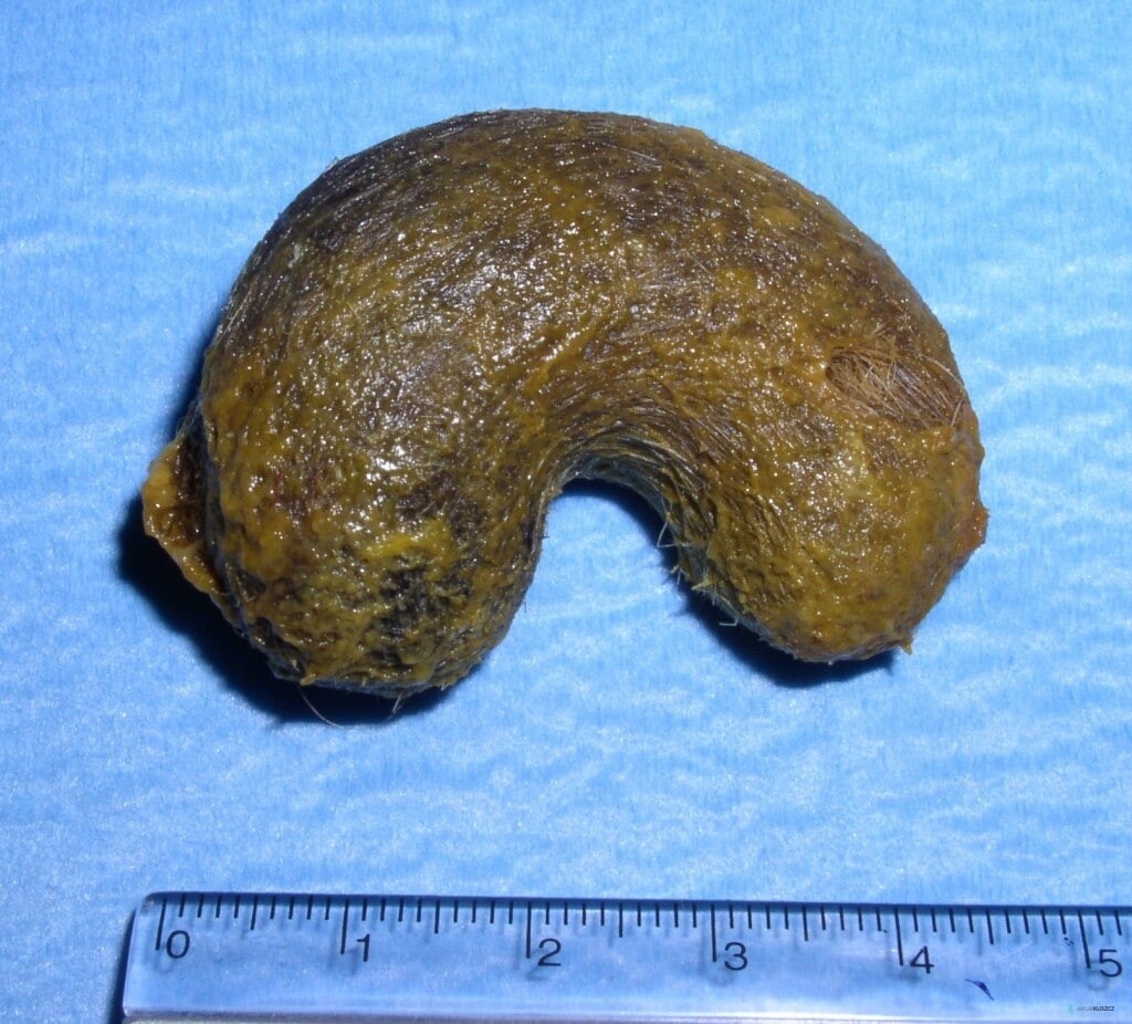 Фитобезоар. Фото взято из интернета