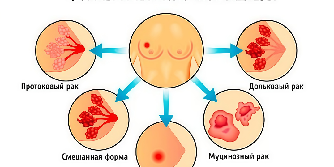 Типы рака молочной железы: как в них разобраться?